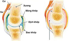 Dùng methotrexat điều trị thấp khớp cho đúng